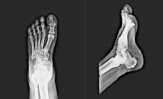 Digital Foot X-ray